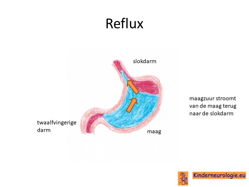 reflux